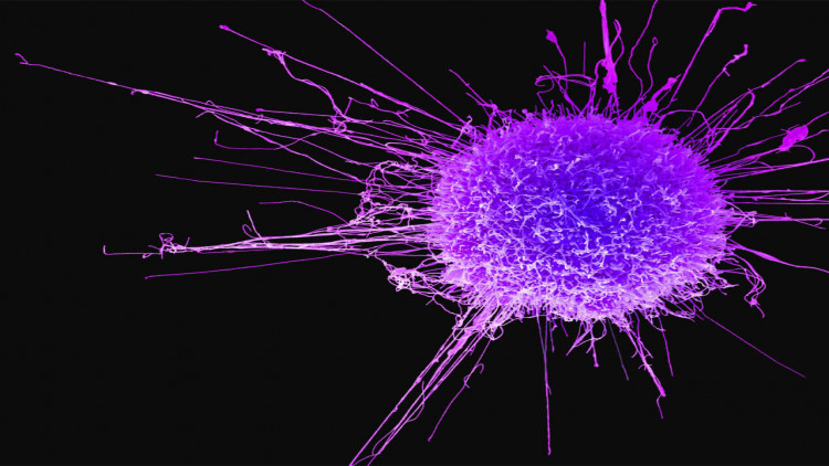 Alimlər xərçəngdən ölümün əsas səbəbini tapdılar