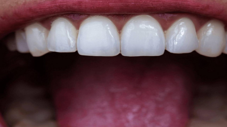 Dişləri evdə tez ağartmaq üsulları - Açıqlama