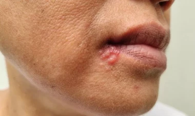 Həkim açıqladı: Uçuğu başlamadan dayandırmq mümkündür