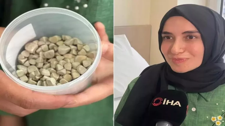21 yaşlı Fatmanın bədənindən 287 daş çıxarıldı – tibb aləmi şokda - FOTO