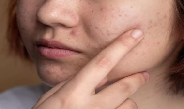 Bu fəsildə üzünüzü müalicə etməyin, ləkələr qala bilər - Açıqlama