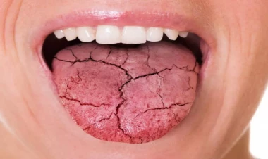 Daimi ağız quruluğu bu xəstəliyin əlaməti ola bilər - Açıqlama
