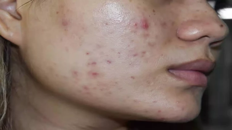 Bu qidalar üzdə sızanaq yaradır - Açıqlama