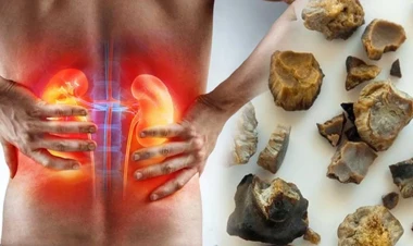Alimlər böyrək daşlarına yeni çarə TAPDI - FOTO