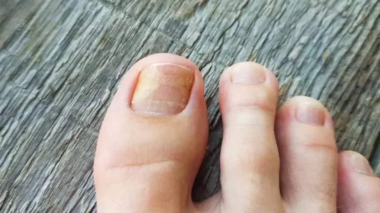 Soyuq havalarda dırnaq ətrafında göbələk riski artır – Xalq təbabətinə əsaslanan 3 effektiv üsul