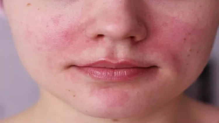 Yayda üz dərisi səpkilərini necə müalicə etmək olar?