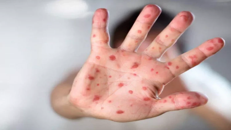 Azərbaycanda qızılca və suçiçəyi ilə bağlı epidemioloji vəziyyət necədir?