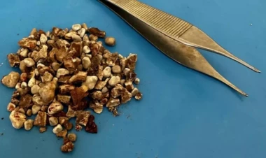 Dəhşətli hadisə: İki böyrəyindən 300-dən çox daş çıxarıldı