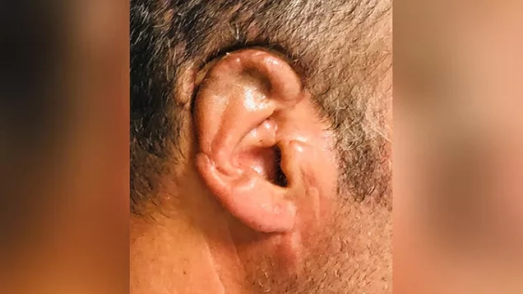 Bakıda kişinin qopan qulağını 34 saat sonra yerinə tikdilər - FOTO