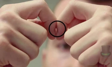 Ağciyər xərçənginin gizli əlaməti - Barmaq uclarına diqqət yetirin