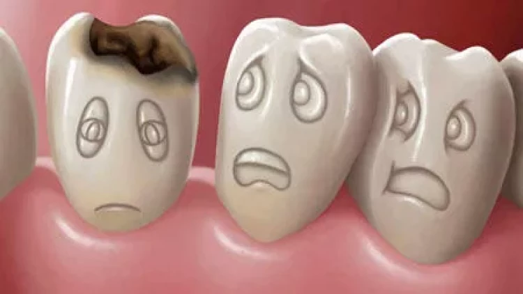 Niyə kariyes tez-tez təkrarlanır? - SƏBƏBLƏR