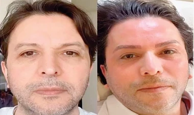 Estetik etdirib özünü tanınmaz hala saldı - FOTO