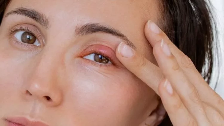Qızarmış göz qapaqları bu xəstəliyin əlamətidir - DİQQƏT