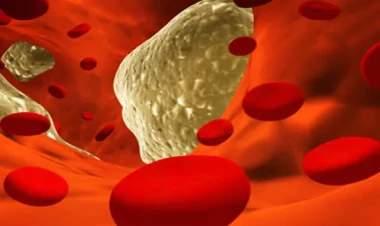 Xolesterol səviyyəsini necə idarə etməli?