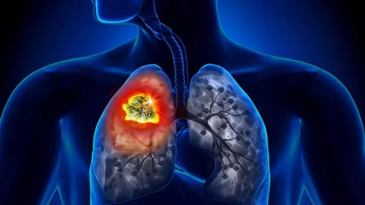 Alimlər ölümcül ağciyər xəstəliyinin səbəbini aşkarlayıblar