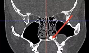 Qrip şikayəti ilə həkimi getdi, burnundan diş çıxdı - FOTO
