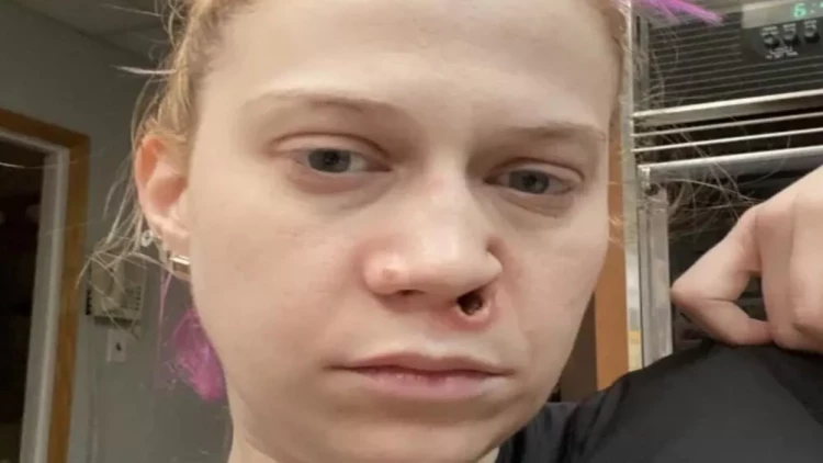 Narkotik aludəçisi qadının burnu qopdu - 