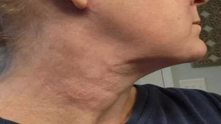 Boğazında ət qalan polkovnik öldü