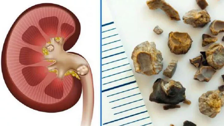 Böyrək daşı nədən yaranır? - İndiyə qədər deyilənləri unudun...
