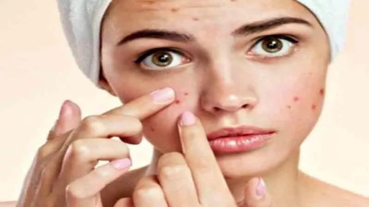 Sızanaqların kökünü kəsən vasitələr