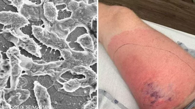 Bu ölkədə ət yeyən bakteriyalar insanları iki gündə öldürür