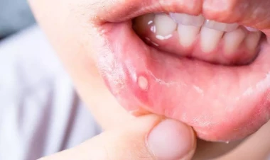 Stomatiti bir gecədə sağaldan çarə