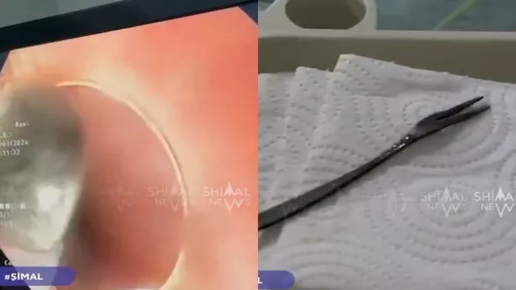 Xaçmaz sakininin mədəsindən çəngəl çıxdı