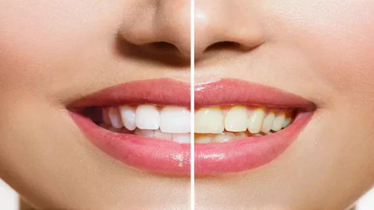 Dişlərin saralmasının əsas 9 səbəbi