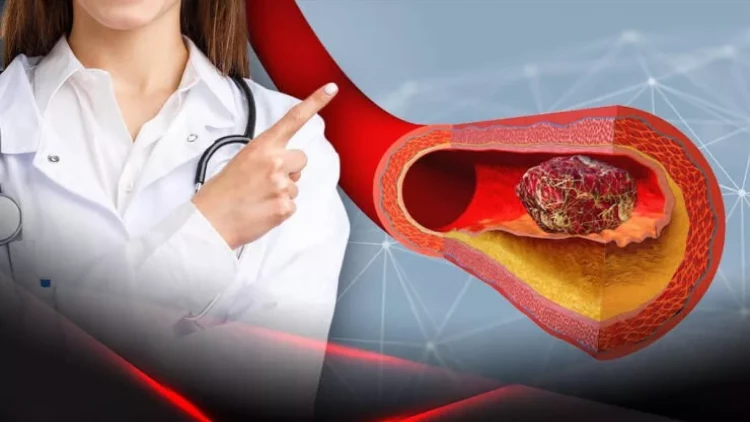 Qadınlarda qan laxtalanması riskini artıran DƏRMANLAR