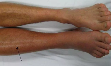 36 yaşlı kişidə 20 sm-lik tromb tapıldı