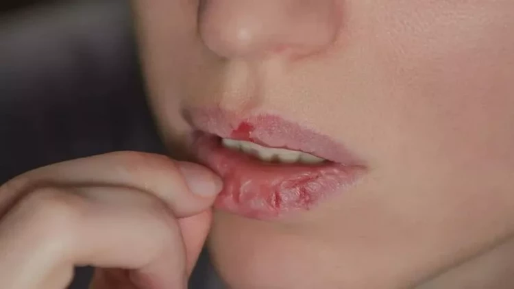 Dodaq dişləmək vərdişinə nə səbəb olur? - CAVAB