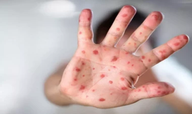 “Qızılca qeydə alınan siniflərdə şagirdlər tibbi müşahidəyə götürülür”