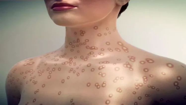 Bu ölkədə sifilisə yoluxmada rekord artım