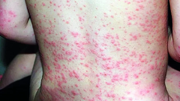 Qızılca aqressivləşir: yaşlılar da təhlükədə - köhnə peyvəndlər təsirsizdir?