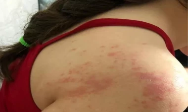 Aptekdən aldığı dərman qızın bədənini bu hala saldı - FOTO