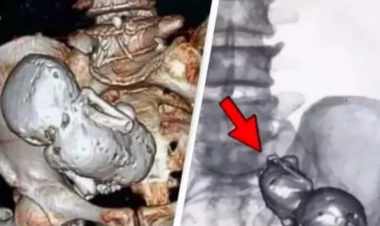 Tibbdə NADİR HADİSƏ: 73 yaşlı qadının bətnində “daş körpə” tapıldı - FOTO