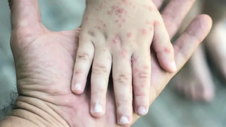 Qızılcadan necə qorunmaq olar?