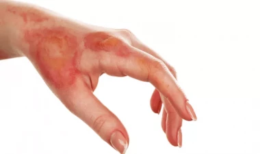 Yanıqlar zamanı ilk yardım nə olmalıdır?