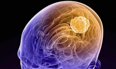 Beyin şişinin qəribə əlamətləri – Onkoloqdan