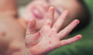 Tanınmış pediatr qızılca ilə bağlı hər şeyi açıqladı: Peyvəndi bu vaxt vurdurun