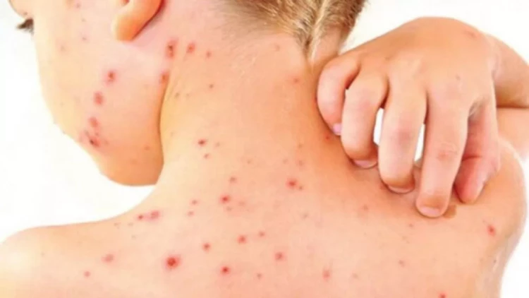 Qızılcadan ölən 2 yaşlı uşaqla bağlı YENİ XƏBƏR