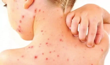 Qızılcadan ölən 2 yaşlı uşaqla bağlı YENİ XƏBƏR