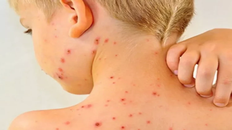 Ölkəni cənginə alan qızılca hansı hallarda ölümə səbəb olur? – PEDİATR DANIŞDI