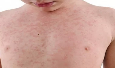 Azərbaycanda qızılcaya yoluxma halları artır - RƏSMİ