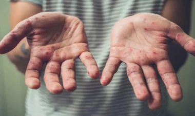 Qızılca peyvəndi göstərişə görə vurulmalıdır - İnfeksionist