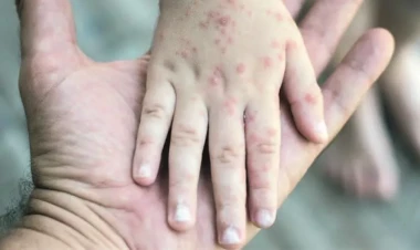 Qızılcadan ölən uşaq 3 gün əvvəl xəstəliyə yoluxub – RƏSMİ