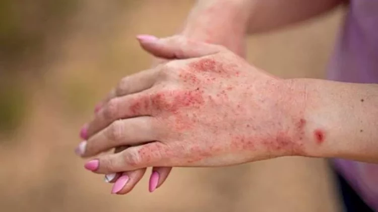 “Qara qızılca” ölümlə nəticələnə bilər - Həkimdən xəbərdarlıq