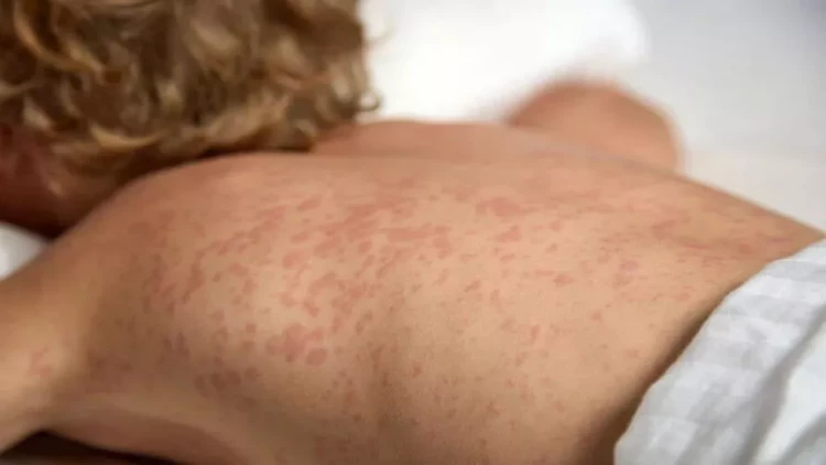 Qızılcanın yayılmasına səbəb... - Pediatr açdı sandığı, tökdü pambığı