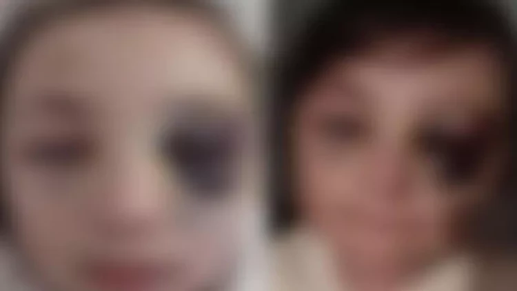 Məktəblinin xəsarətini prokurorluq araşdıracaq