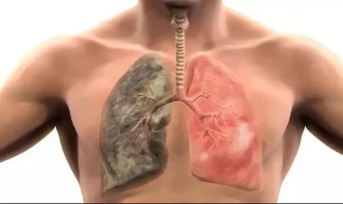 20 il ərzində siqaret çəkən insanın ağciyərlərinin necə görünür?  - FOTO